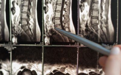 Debunking the Myth: Degenerative Disc Disease Doesn’t Always Equal Pain
